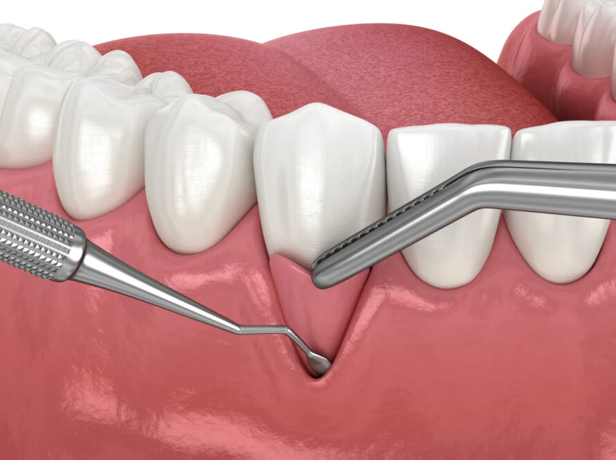 Cirugía Encía | Asistencia Dental Integral